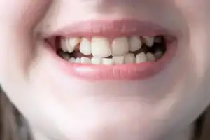 Hoe herken je dat je kind een beugel nodig heeft