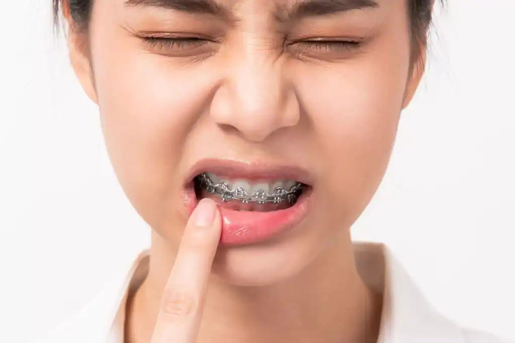 Tips om pijn en irritatie van je beugel te verminderen