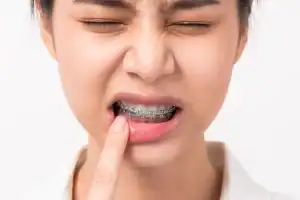 Tips om pijn en irritatie van je beugel te verminderen